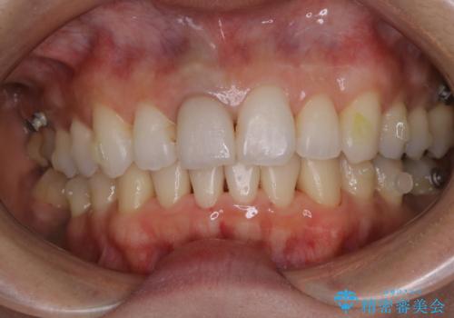 歯列矯正中にPMTCの治療後