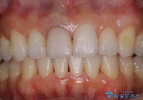 歯列矯正中にPMTCの治療後