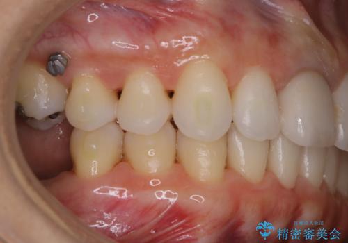 歯列矯正中にPMTCの治療後