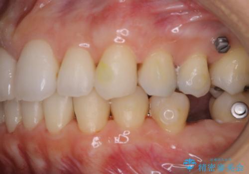 歯列矯正中にPMTCの治療後