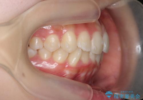 インビザラインライトで行う短期マウスピース矯正治療の治療中