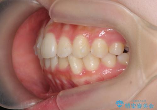 インビザラインライトで行う短期マウスピース矯正治療の治療中