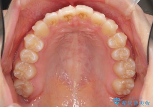 インビザラインライトで行う短期マウスピース矯正治療の治療中
