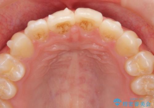 インビザラインライトで行う短期マウスピース矯正治療の治療中