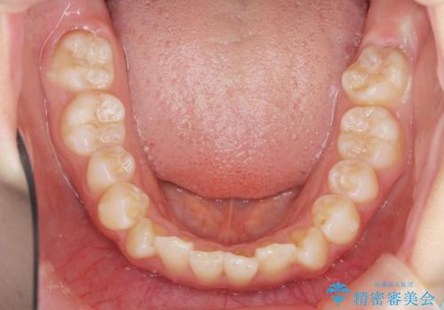 インビザラインライトで行う短期マウスピース矯正治療の治療中