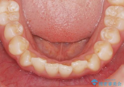 インビザラインライトで行う短期マウスピース矯正治療の治療中