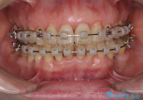 口元の出っ張りとデコボコを改善したいの治療中