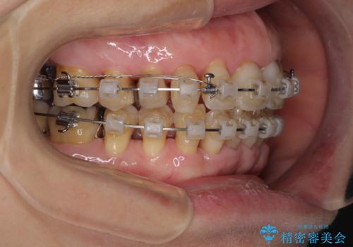 口元の出っ張りとデコボコを改善したいの治療中