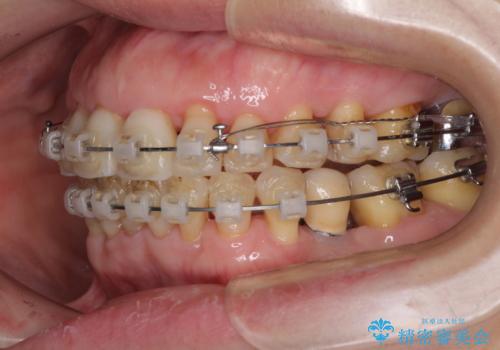 口元の出っ張りとデコボコを改善したいの治療中