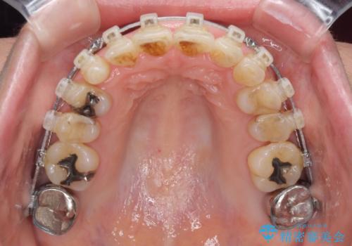 口元の出っ張りとデコボコを改善したいの治療中