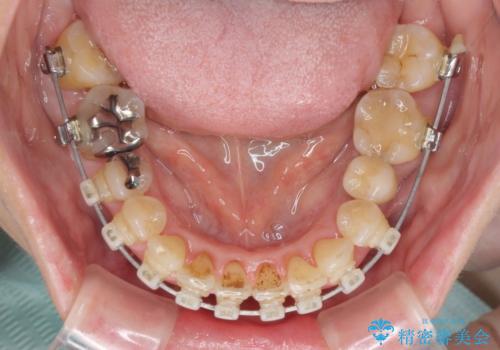 口元の出っ張りとデコボコを改善したいの治療中