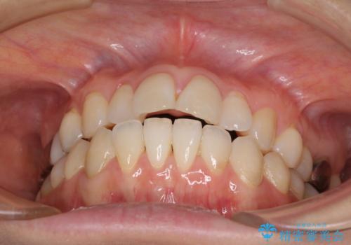 気になる前歯をインビザライン・ライトで 矯正治療後には銀歯をセラミックにの治療前