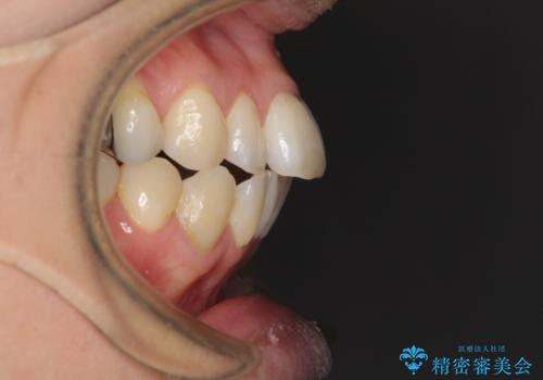 気になる前歯をインビザライン・ライトで　矯正治療後には銀歯をセラミックにの治療前
