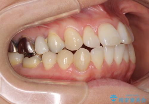 気になる前歯をインビザライン・ライトで 矯正治療後には銀歯をセラミックにの治療前