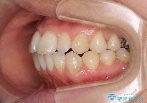 気になる前歯をインビザライン・ライトで 矯正治療後には銀歯をセラミックにの治療前