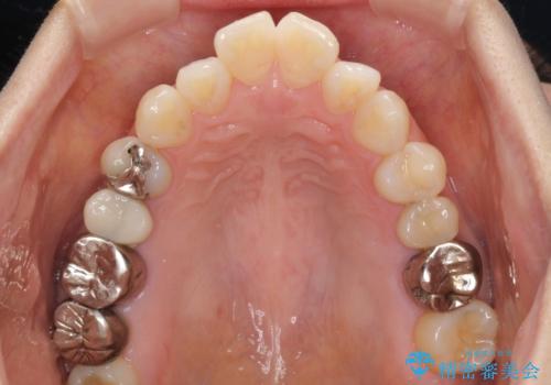 気になる前歯をインビザライン・ライトで 矯正治療後には銀歯をセラミックにの治療前