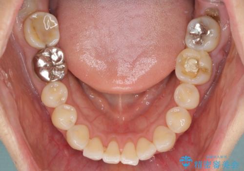 気になる前歯をインビザライン・ライトで 矯正治療後には銀歯をセラミックにの治療前