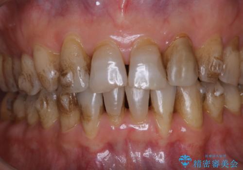 矯正が終了するタイミングでクリーニング(PMTC)の治療前