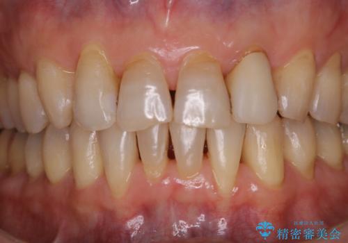 矯正が終了するタイミングでクリーニング(PMTC)の治療後