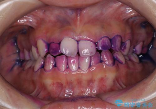 歯の染め出しとPMTCで口腔内ケアの治療前