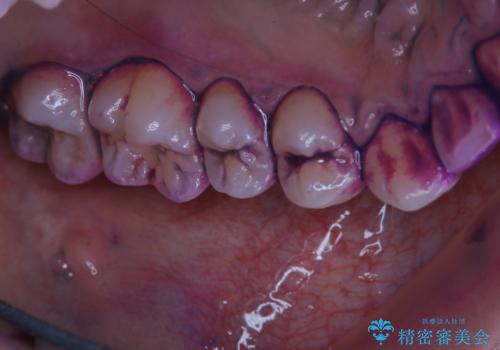 歯の染め出しとPMTCで口腔内ケアの治療前