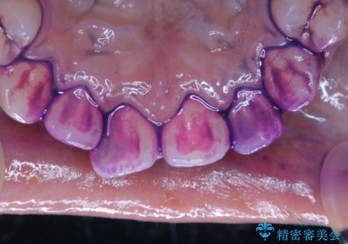 歯の染め出しとPMTCで口腔内ケアの治療前