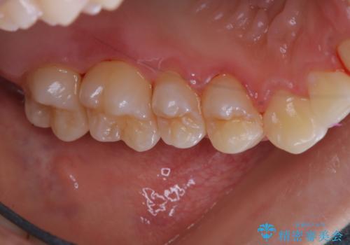 歯の染め出しとPMTCで口腔内ケアの治療後