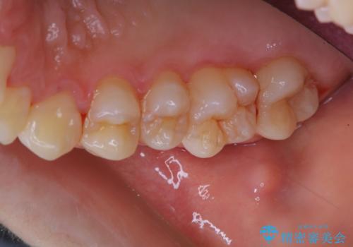 歯の染め出しとPMTCで口腔内ケアの治療後