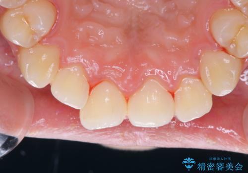 歯の染め出しとPMTCで口腔内ケアの治療後