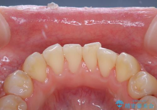 歯の染め出しとPMTCで口腔内ケアの治療後
