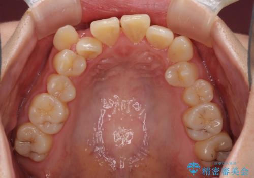 補助装置を使ったインビザラインによる抜歯矯正の治療前