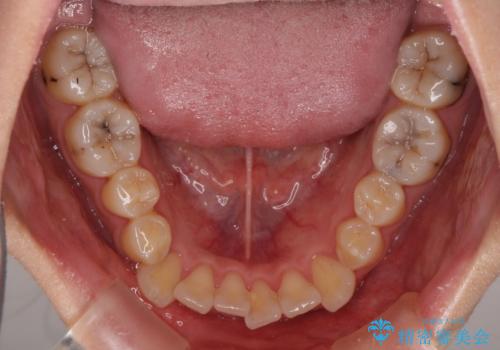 補助装置を使ったインビザラインによる抜歯矯正の治療前