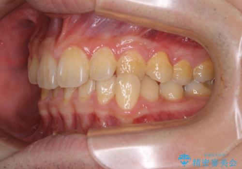 矯正前クリーニング(PMTC)の治療前
