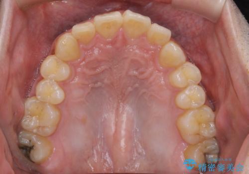 矯正前クリーニング(PMTC)の治療前