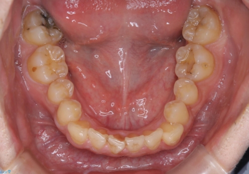 矯正前クリーニング(PMTC)の治療前
