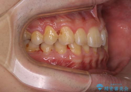 矯正前クリーニング(PMTC)の治療前