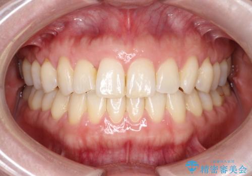 上の歯と下の歯が反対にかんでいる　インビザラインによる目立たない矯正の症例 治療後