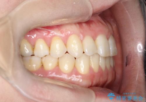 上の歯と下の歯が反対にかんでいる インビザラインによる目立たない矯正の治療後