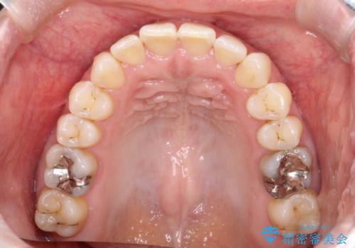 上の歯と下の歯が反対にかんでいる インビザラインによる目立たない矯正の治療後