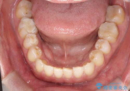 上の歯と下の歯が反対にかんでいる インビザラインによる目立たない矯正の治療後