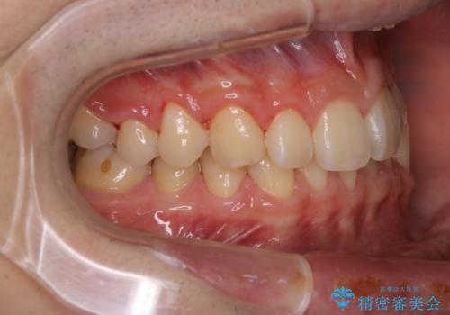 矯正前クリーニング(PMTC)の治療後