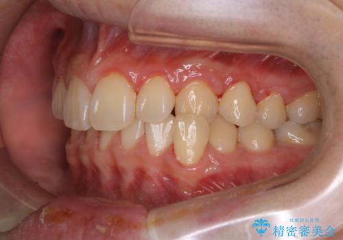 矯正前クリーニング(PMTC)の治療後
