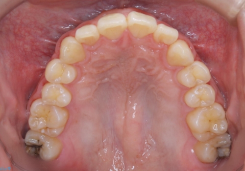 矯正前クリーニング(PMTC)の治療後