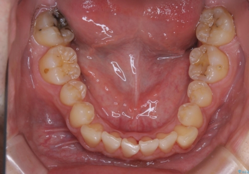 矯正前クリーニング(PMTC)の治療後