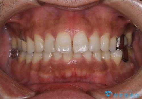 タバコやコーヒーによる着色落とし(PMTC)の治療前