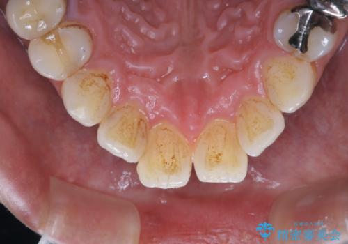タバコやコーヒーによる着色落とし(PMTC)の治療前