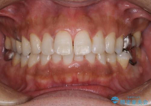 タバコやコーヒーによる着色落とし(PMTC)の治療後