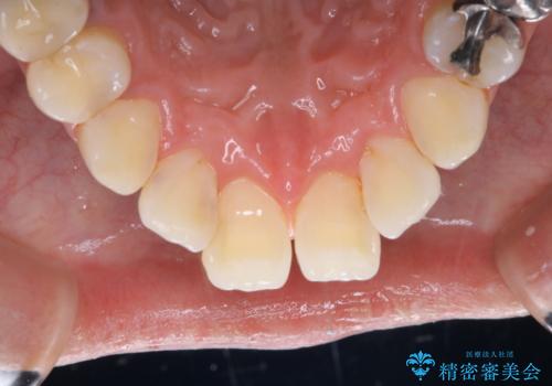 タバコやコーヒーによる着色落とし(PMTC)の治療後
