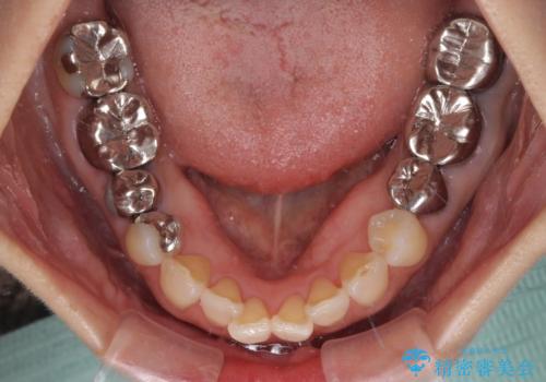 痛む奥歯と見栄えの悪い前歯　オールセラミックによる補綴治療の治療前