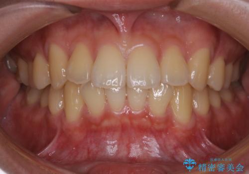 クリスマスにホワイトニングで白くしたいの治療前